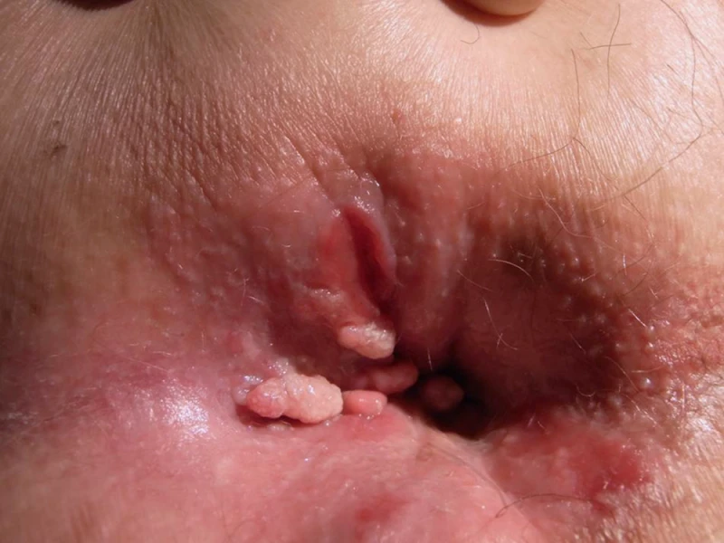 Anal cancer 5