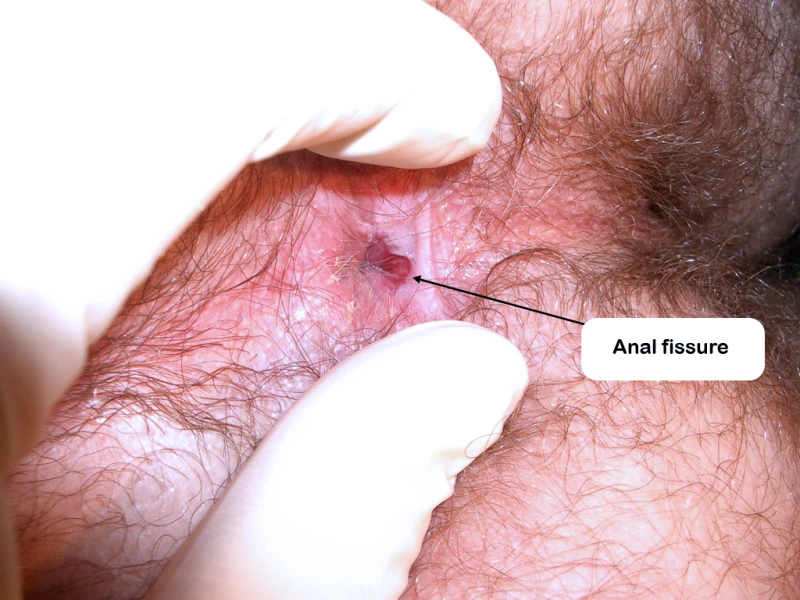Anal fissure 1