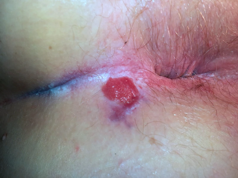 Anal intraepithelial neoplasia 1