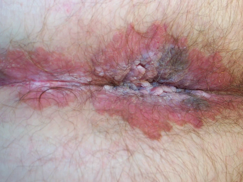 Anal intraepithelial neoplasia 2