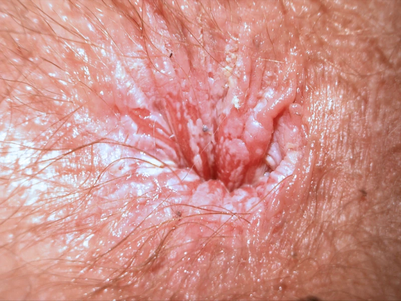 Candidal proctitis
