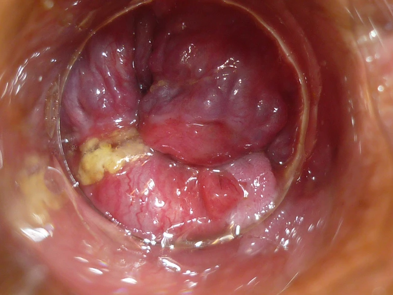 Haemorrhoids 3