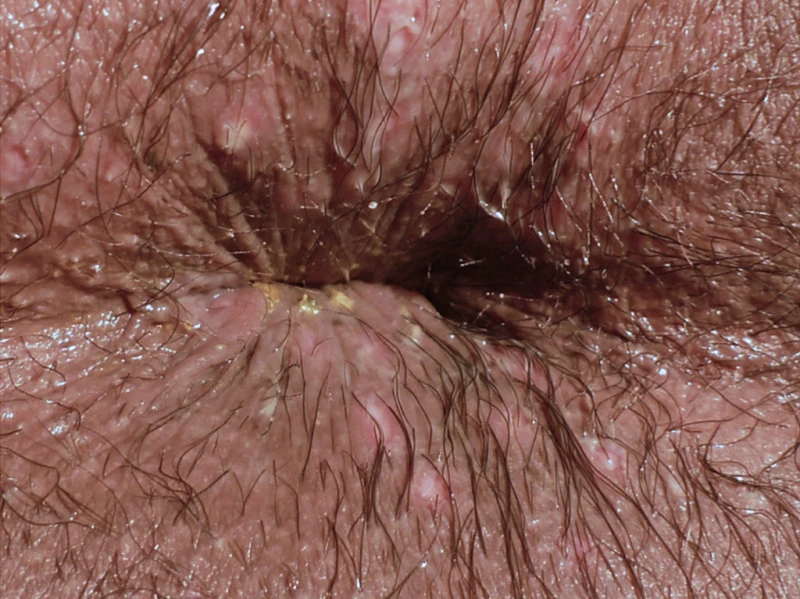 Herpes simplex 2