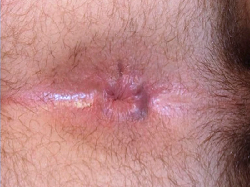 Normal anus