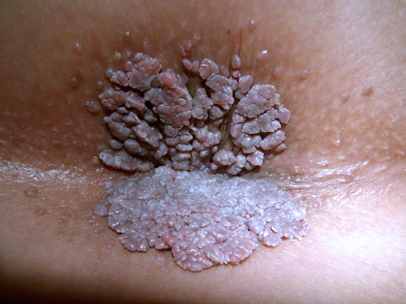Perianal warts 5
