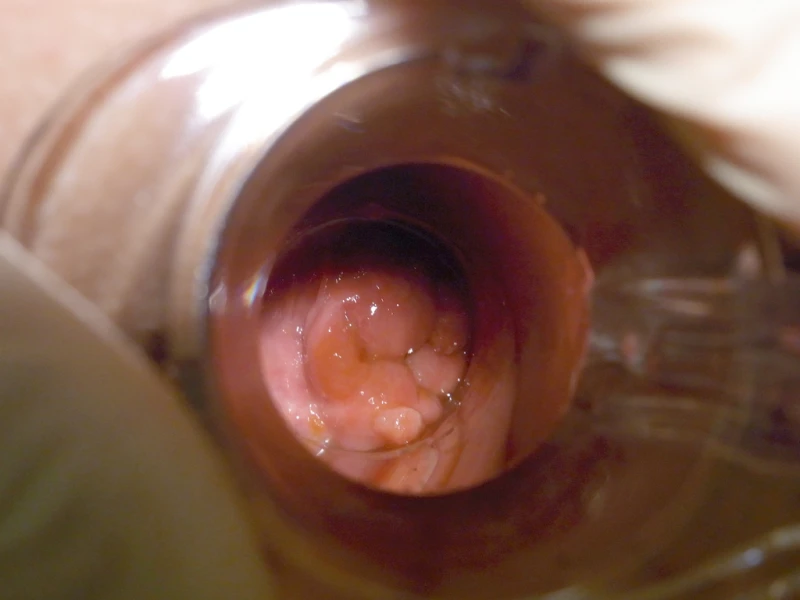 Perianal warts 6