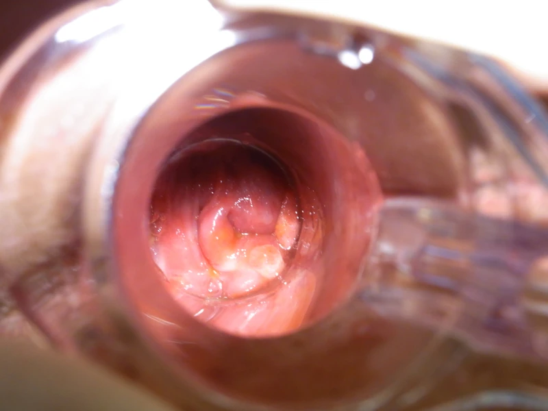 Perianal warts 7