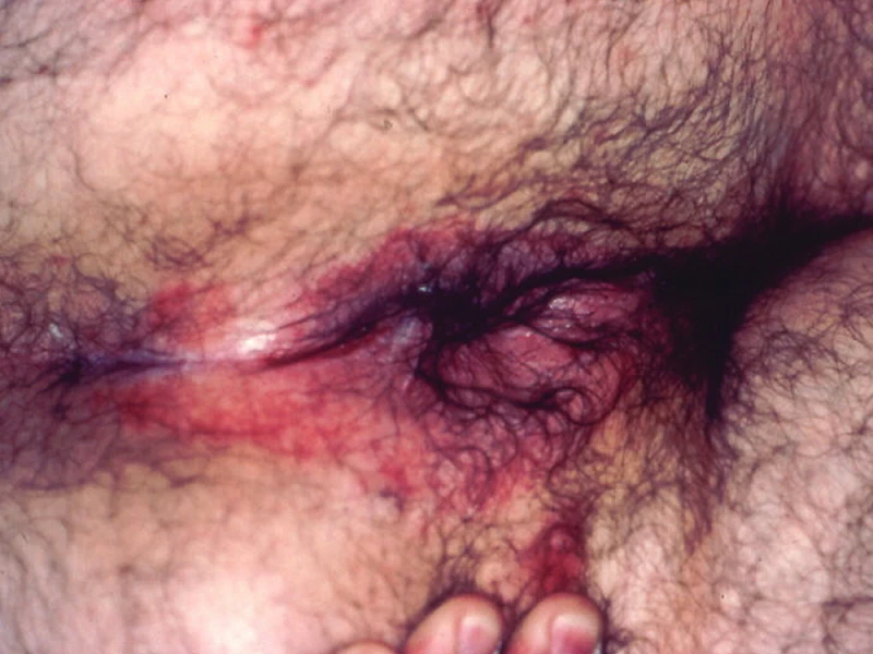 Psoriasis 3