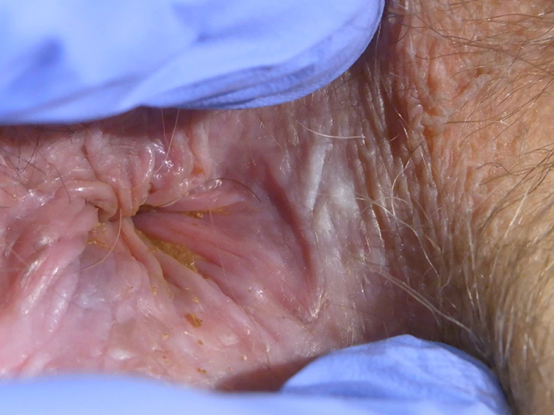 Psoriasis 4