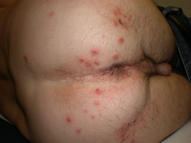 Scabies