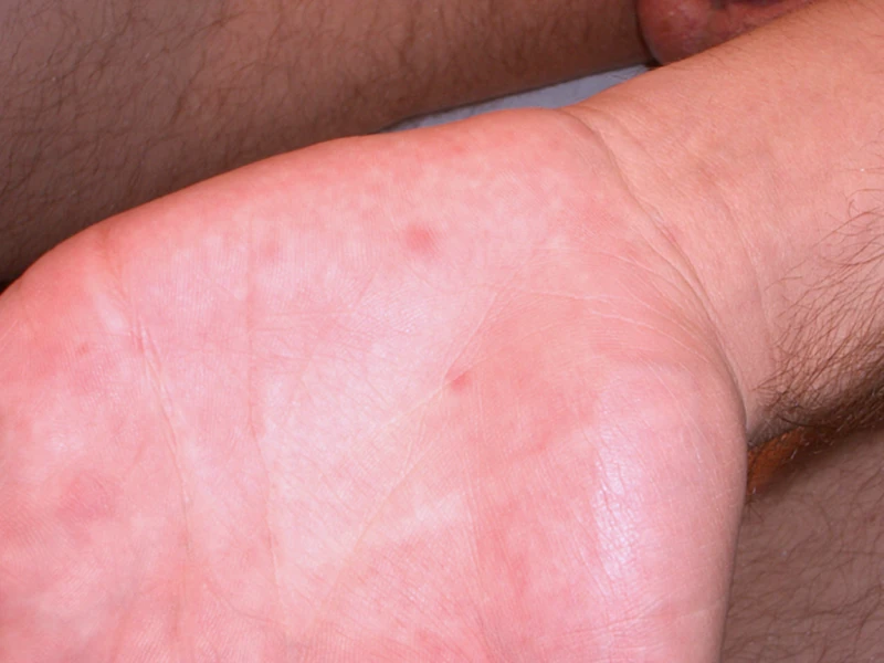 Syphilis rash 3