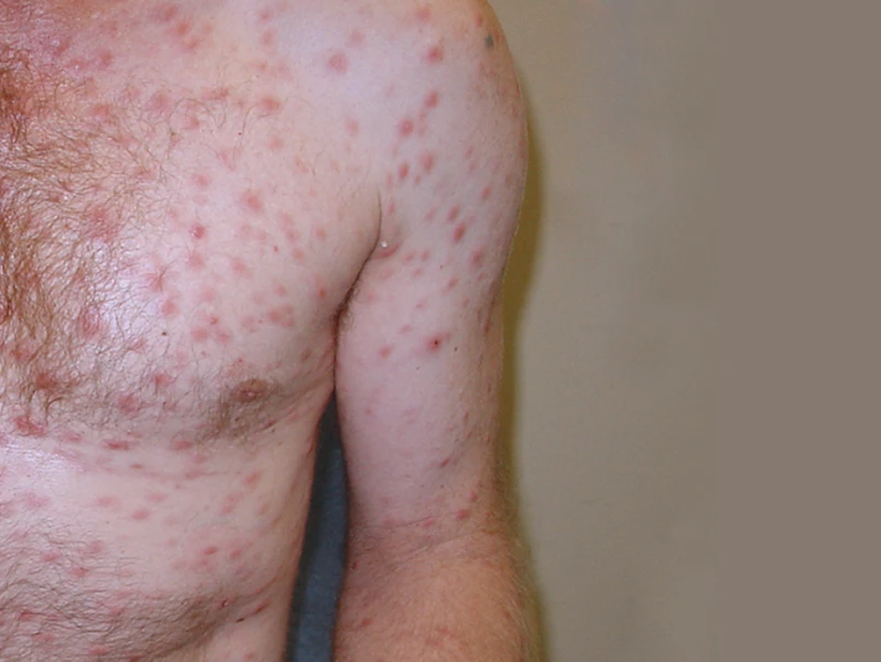 Syphilis rash 5