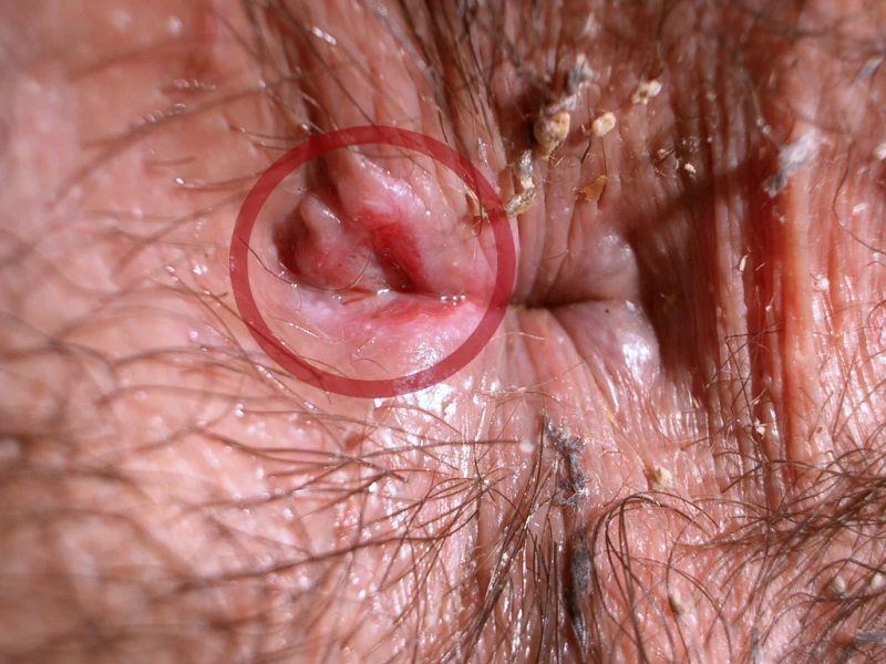 Syphilis ulcer 1