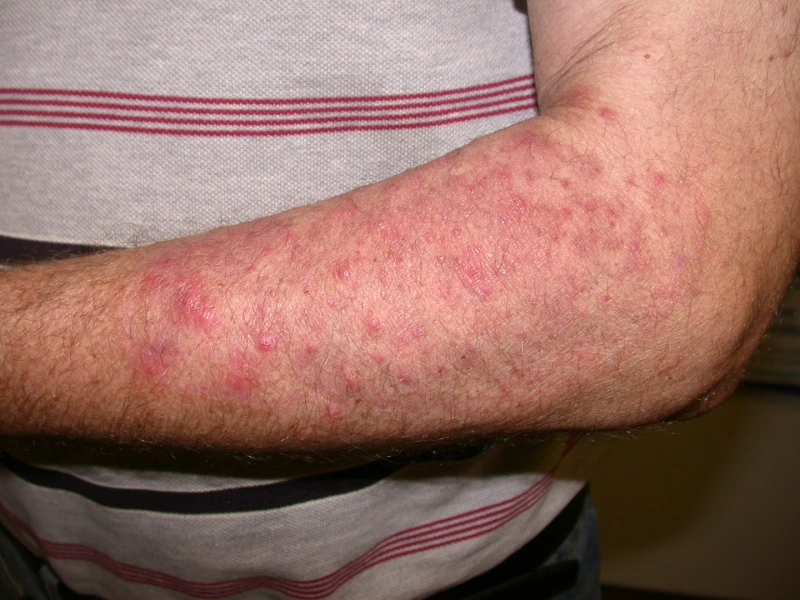 Tinea incognito rash on arm